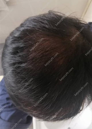 sglow comparison before and after hair growth