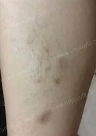 香港最有效的濕疹 療程 清調養