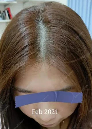 sglow 生髮寶 見證